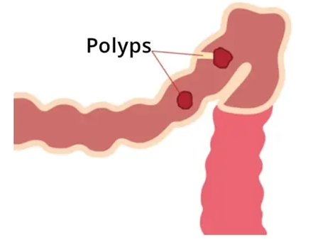 应用 PDOS 对罕见病 FAP 和 MAP 患者进行肿瘤防治